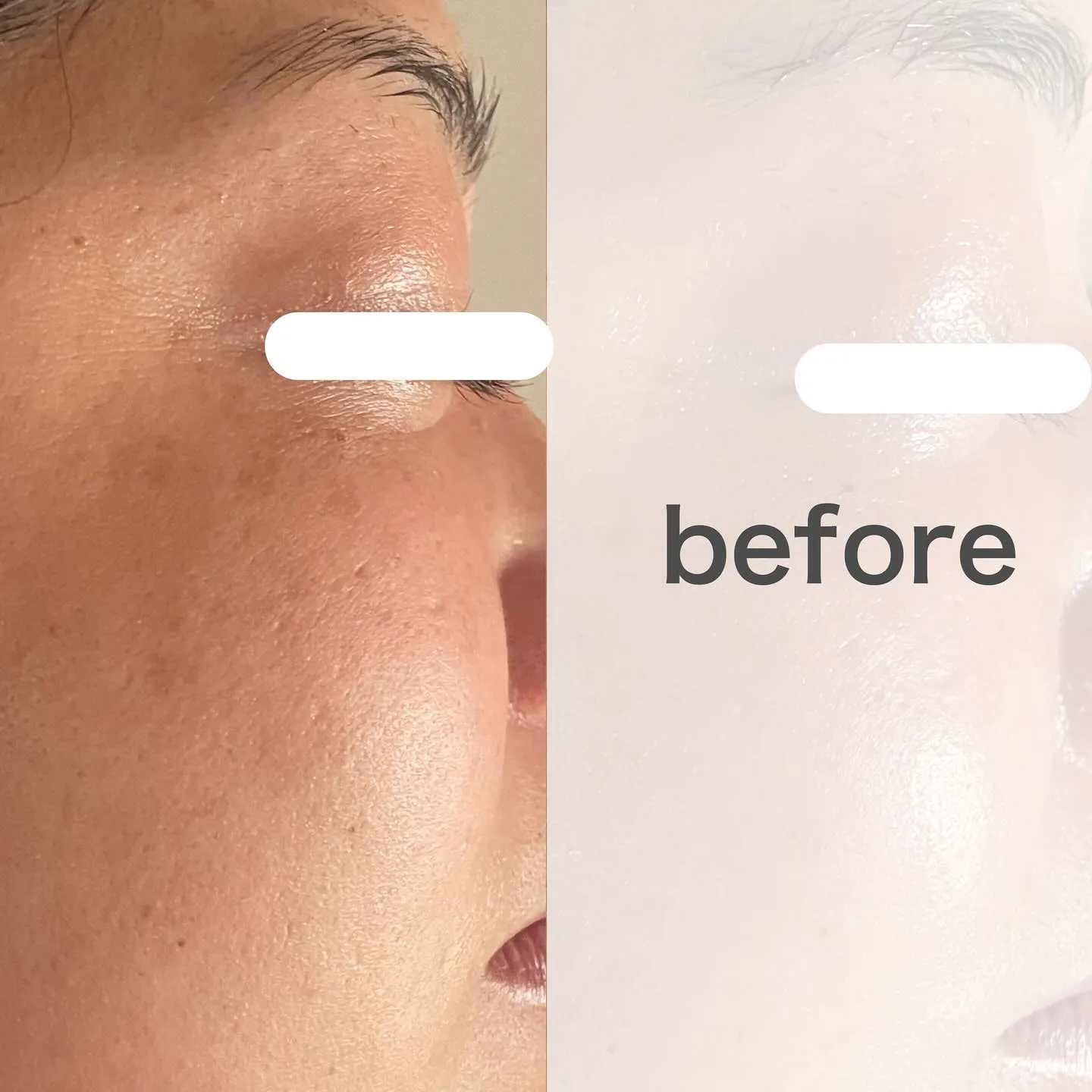 目元のシワ・たるみのお悩みある方は是非お任せ下さい✨✨