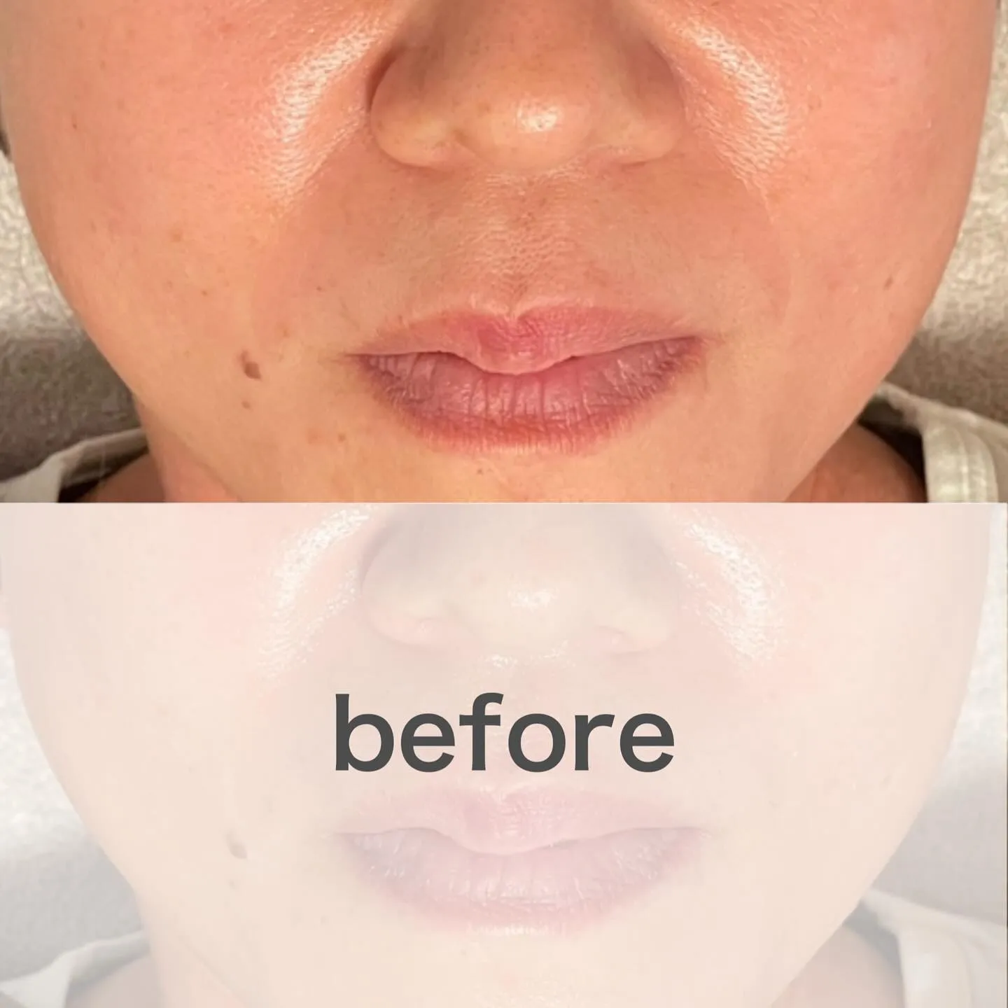 目のシワだけじゃない👀あらゆるシワ薄くします!