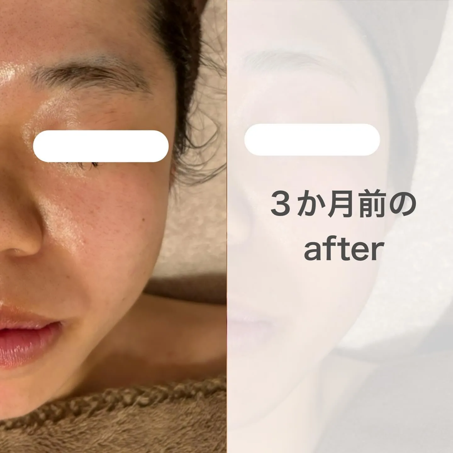 どちらも施術後です！
