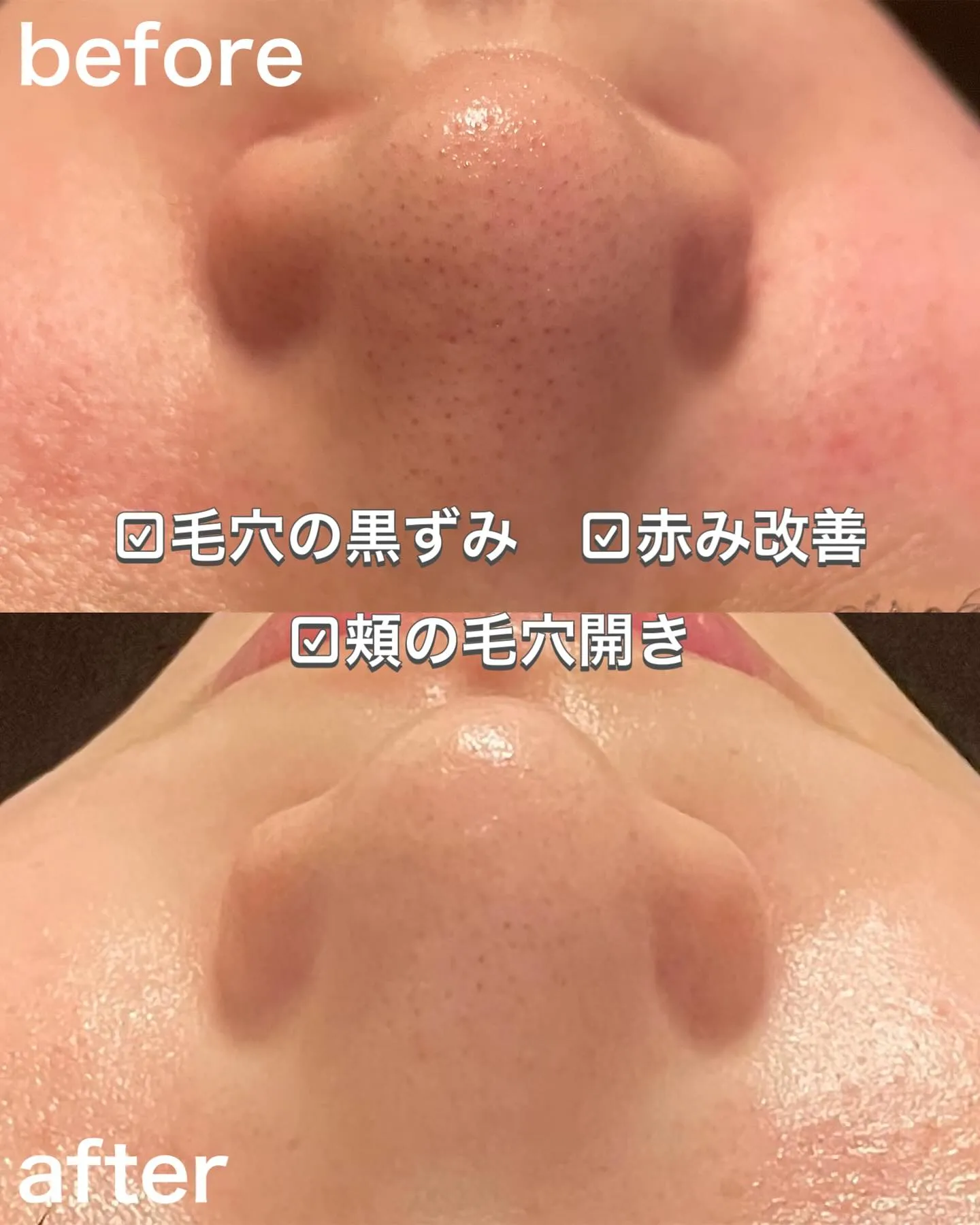 毛穴吸引と酵素洗顔でごっそり！毛穴の黒ずみ、いちご鼻撃退🍓