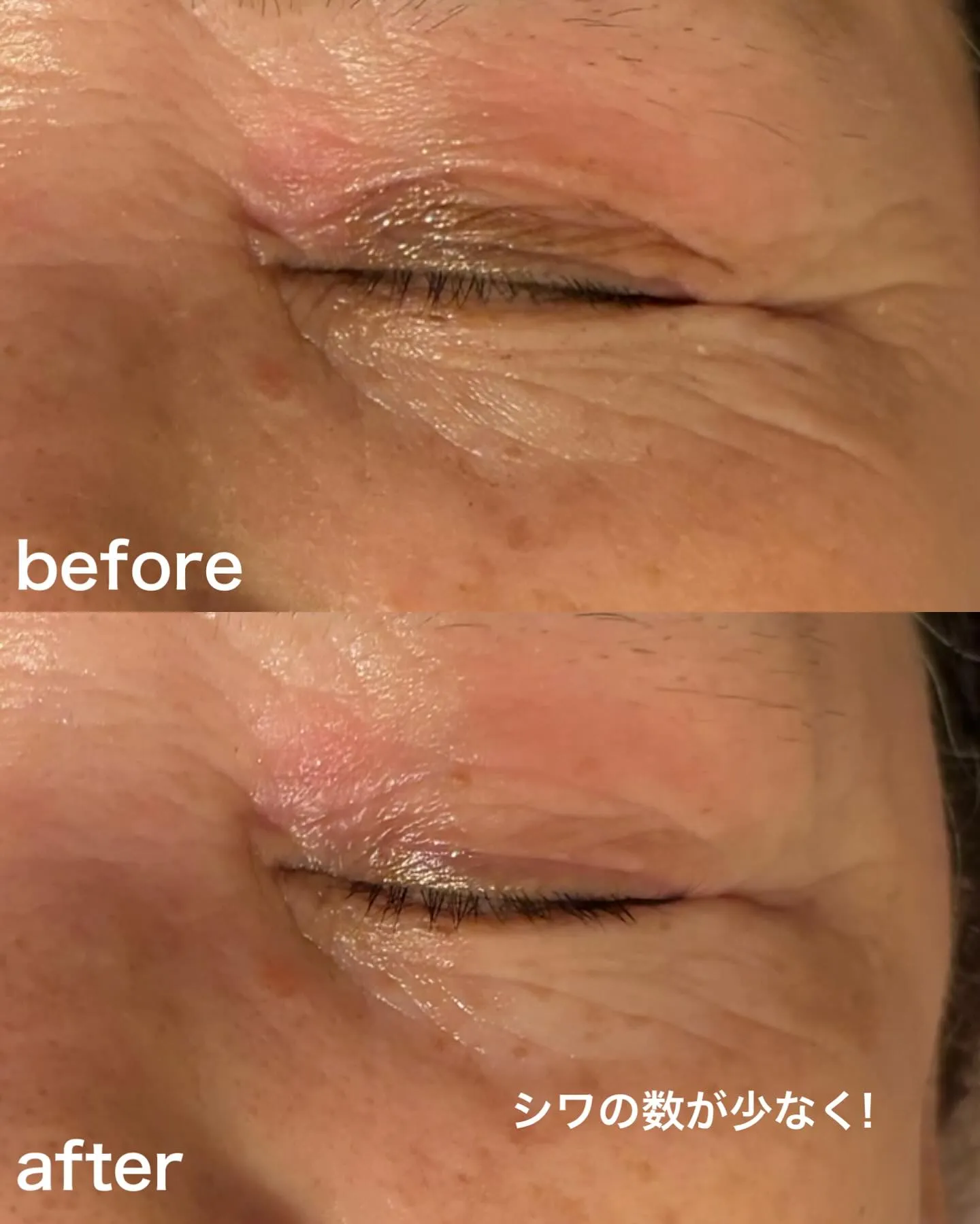 たった1回で👀ビフォーアフターにびっくり！浅草橋のフェイシャ...