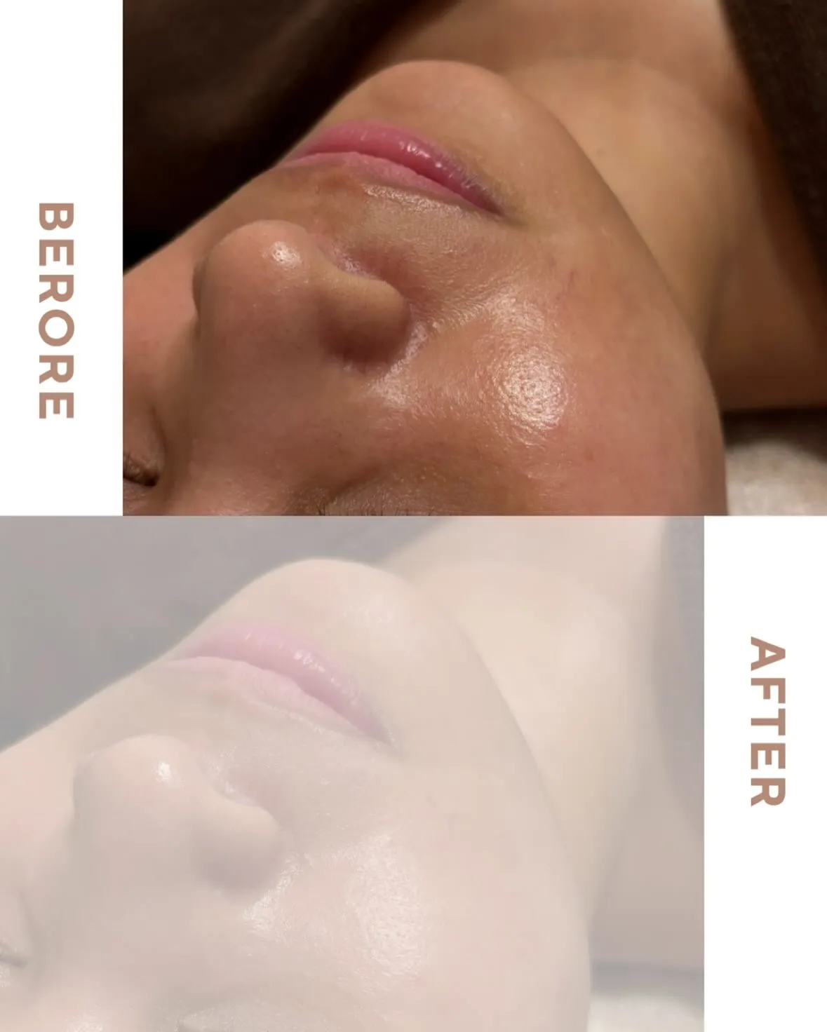 毛穴きゅっ!こんなに綺麗でも目に見える変化が👀浅草橋のエステ...