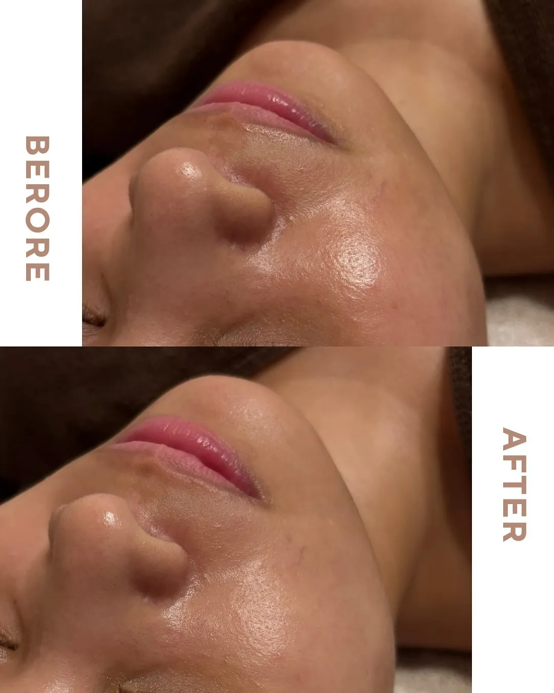 毛穴きゅっ!こんなに綺麗でも目に見える変化が👀浅草橋のエステ...