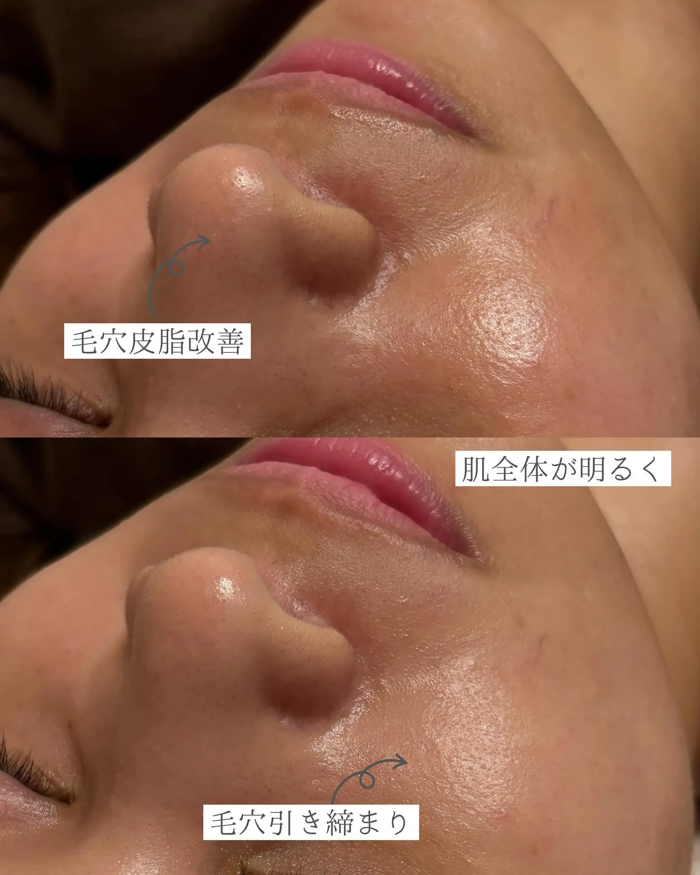 毛穴きゅっ!こんなに綺麗でも目に見える変化が👀浅草橋のエステ...