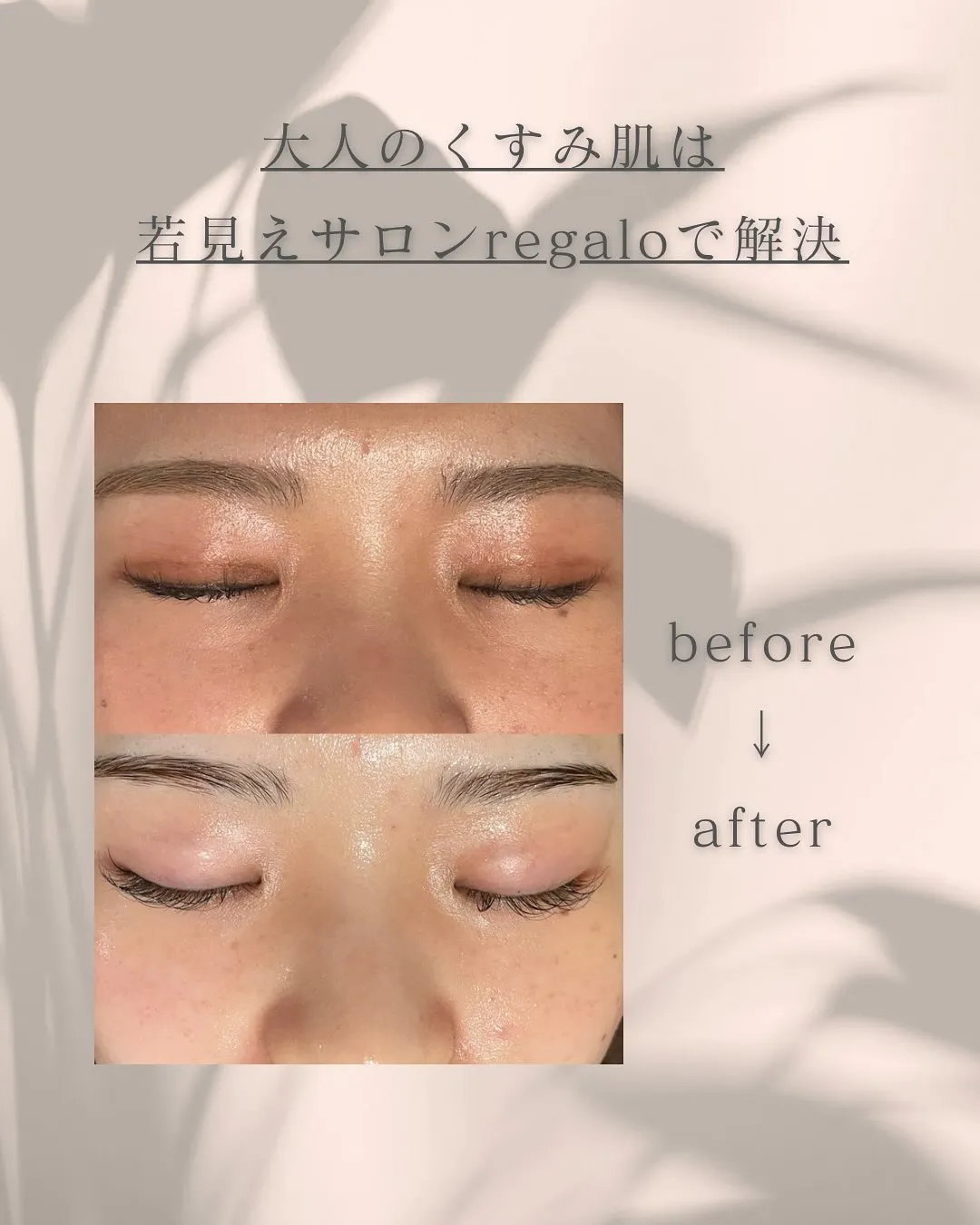 浅草橋の若見えサロンでくすみ肌を透明肌に🫧✨