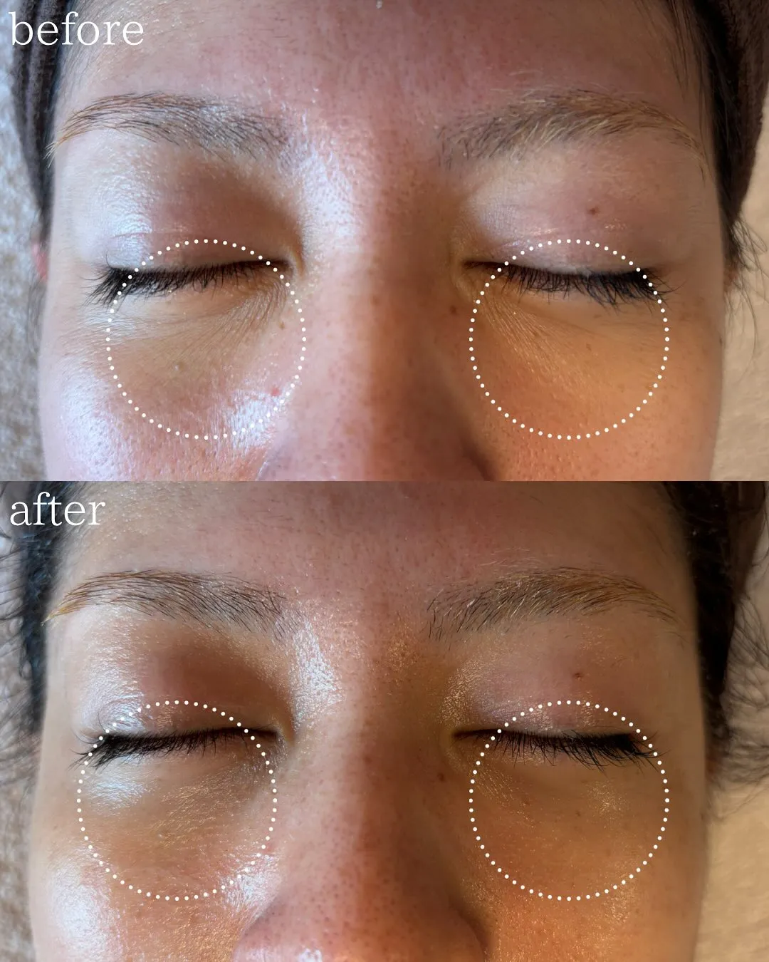 目の、シワとたるみは浅草橋のregaloで解決🌸