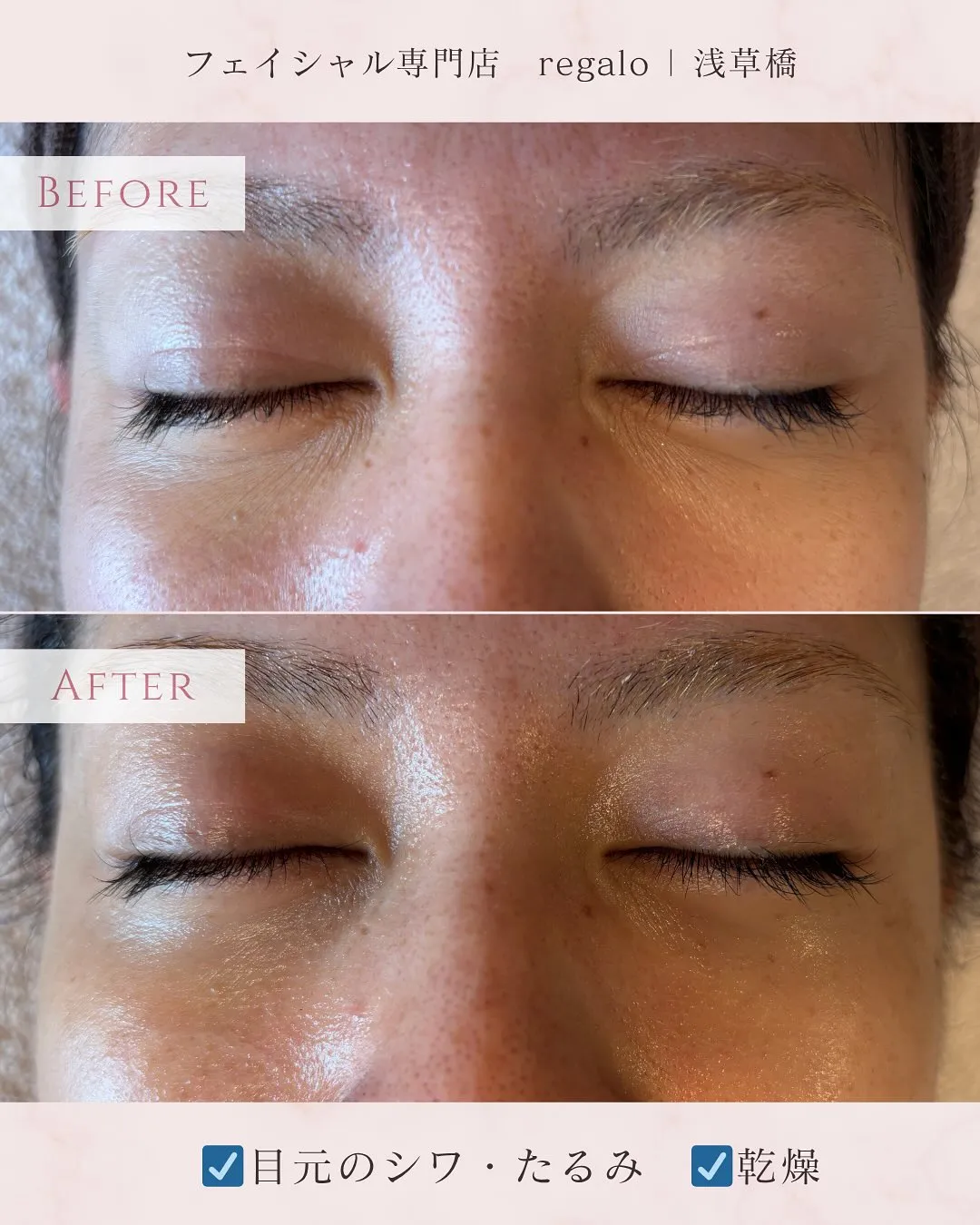 目の、シワとたるみは浅草橋のregaloで解決🌸