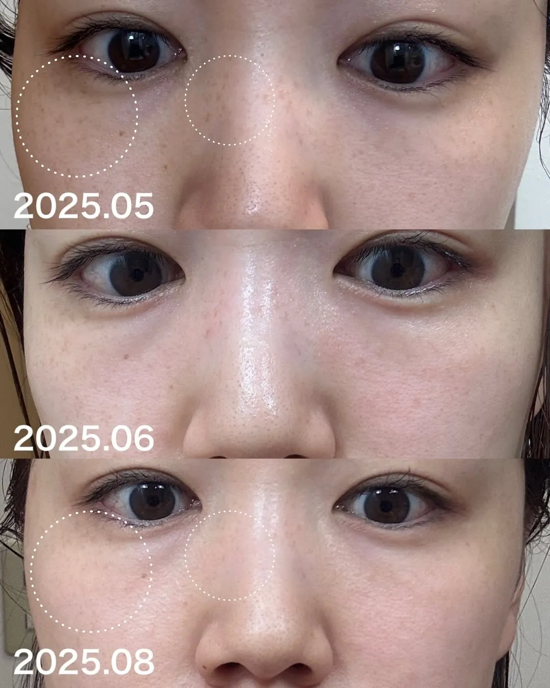 浅草橋の若見えサロンで気になるシミも解決💪✨