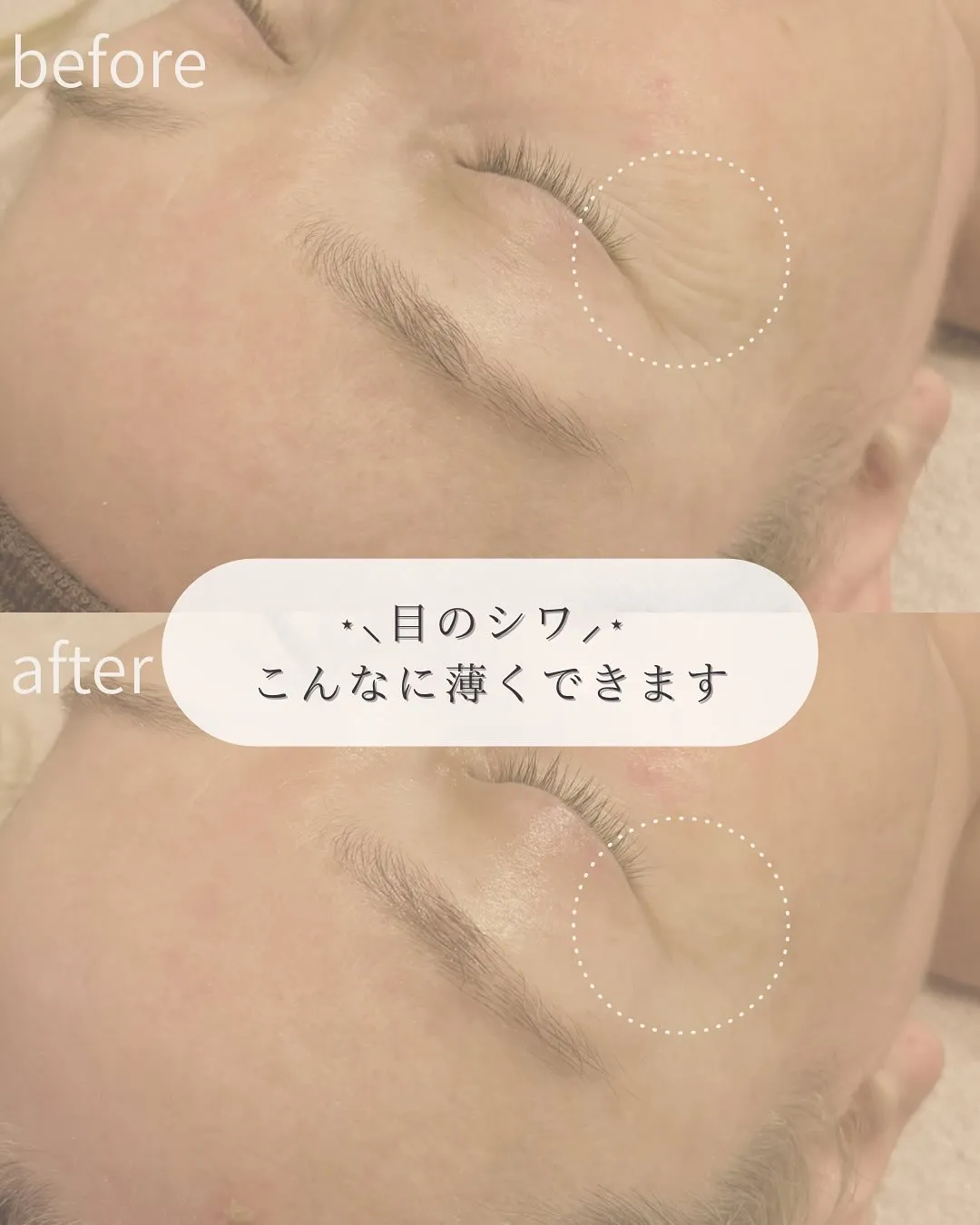 たった1度で!? 目のシワすっきり〜♡