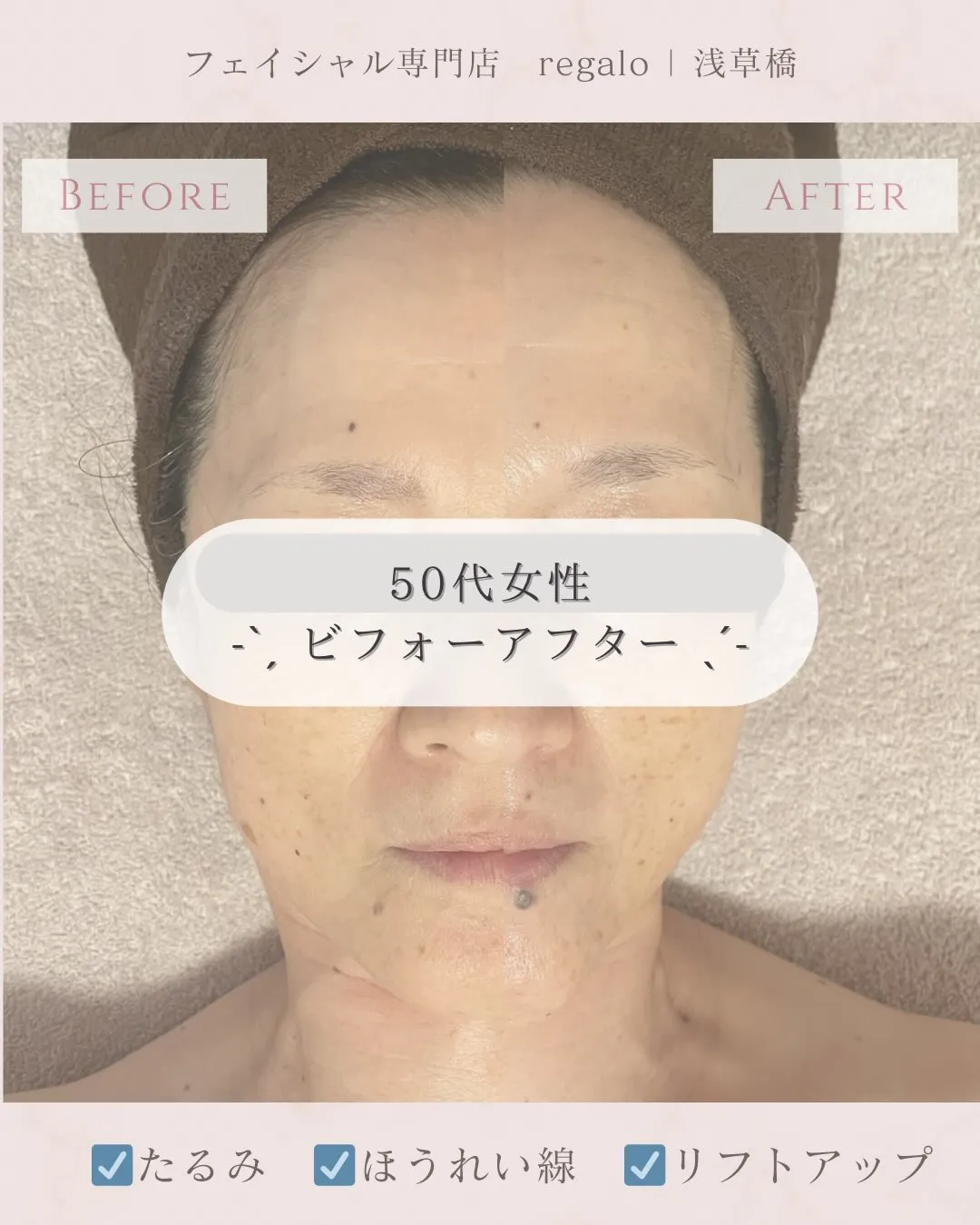 お顔のたるみは浅草橋のregaloで改善💪✨