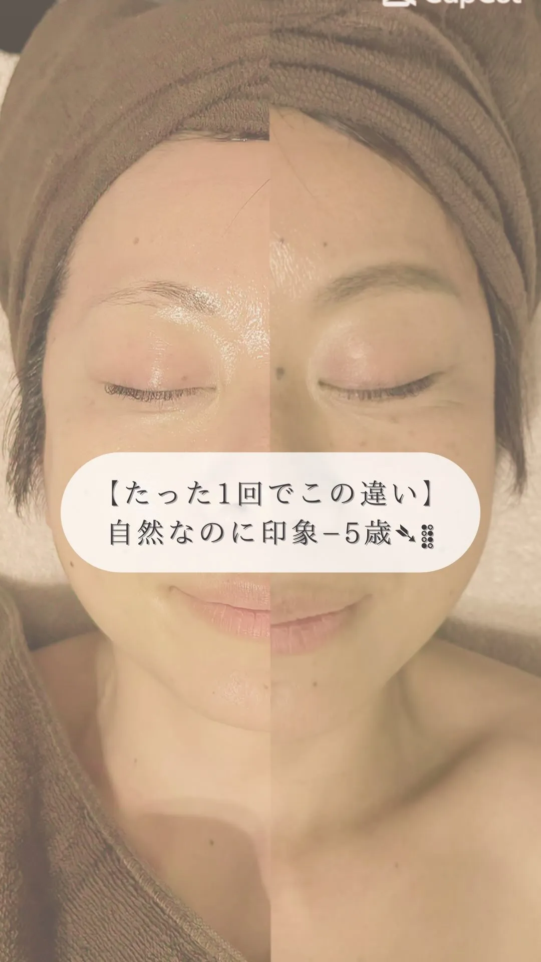 たった1回の施術のビフォーアフター🌸